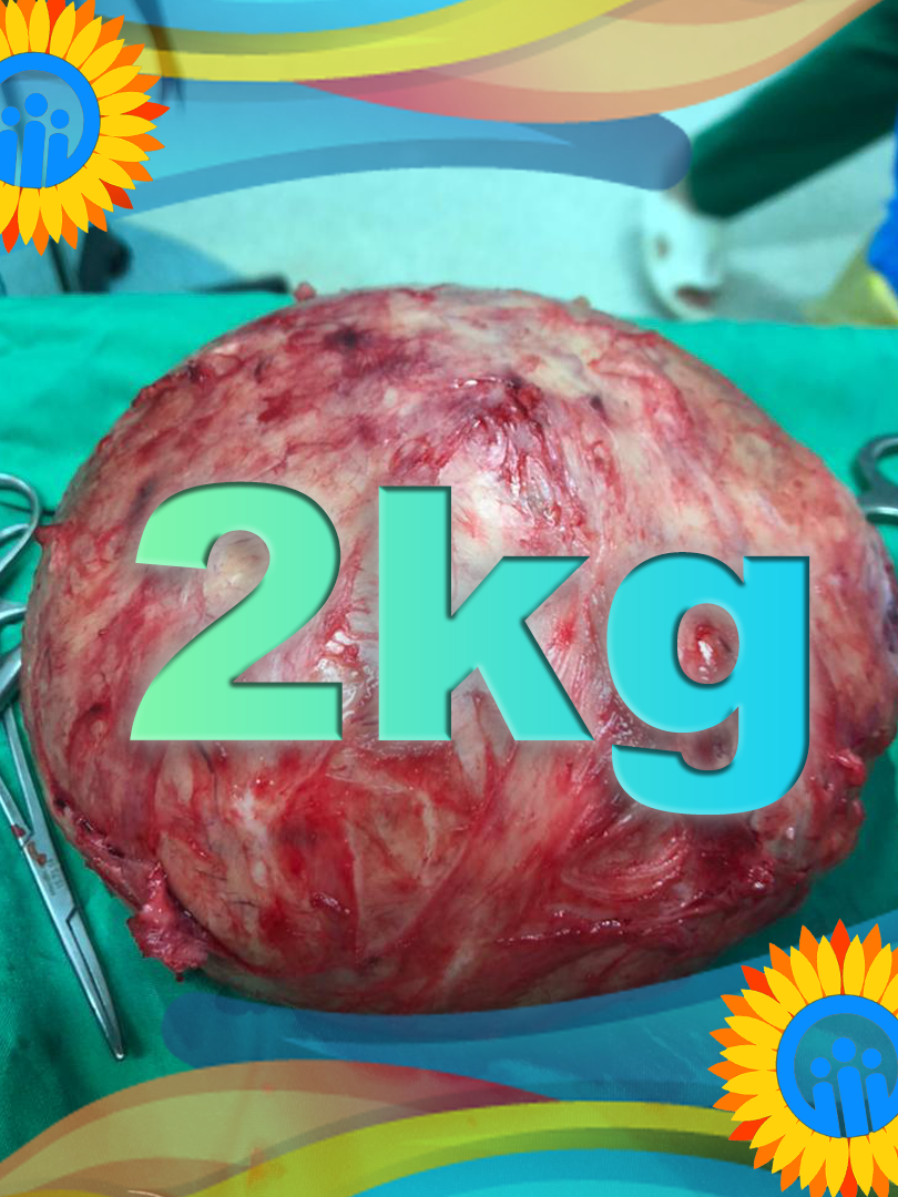 عمل جراحی توده 2 کیلوگرمی